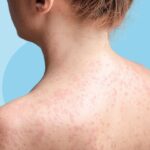 Can You Get Measles if You’re Vaccinated?