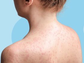 Can You Get Measles if You’re Vaccinated?