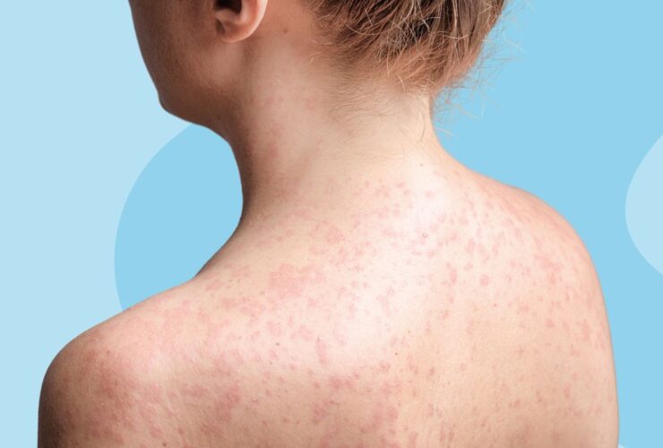 Can You Get Measles if You’re Vaccinated?