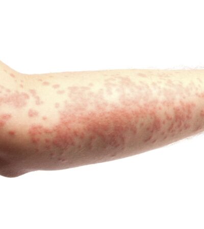 Could a Hives Rash Be a Sign of Thyroid Disease?