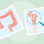 Crohn’s Disease and Osteoporosis: What’s the Connection?
