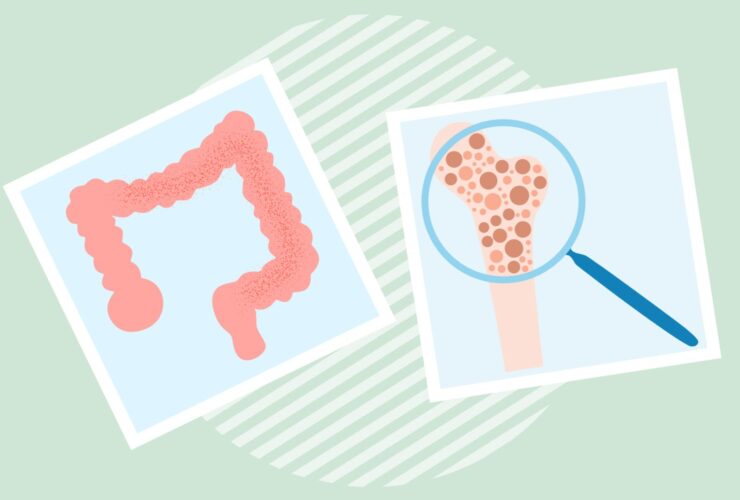 Crohn’s Disease and Osteoporosis: What’s the Connection?