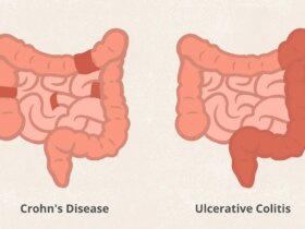 Crohn’s Disease vs. Ulcerative Colitis: What’s the Difference?