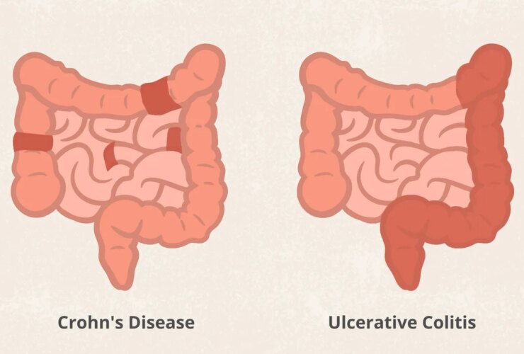 Crohn’s Disease vs. Ulcerative Colitis: What’s the Difference?