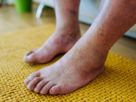 Diabetic Peripheral Neuropathy: Causes, Symptoms