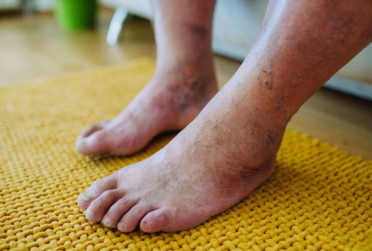 Diabetic Peripheral Neuropathy: Causes, Symptoms