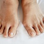 Early Signs of Arthritis in Feet