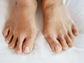 Early Signs of Arthritis in Feet