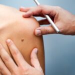 Early-Stage Melanoma: Skin Cancer Treatment