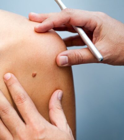 Early-Stage Melanoma: Skin Cancer Treatment
