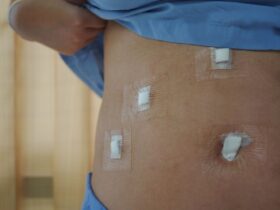 Gallbladder Surgery Recovery Time