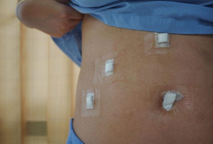 Gallbladder Surgery Recovery Time