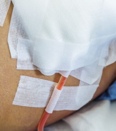 How to Care for Your Surgical Drain at Home