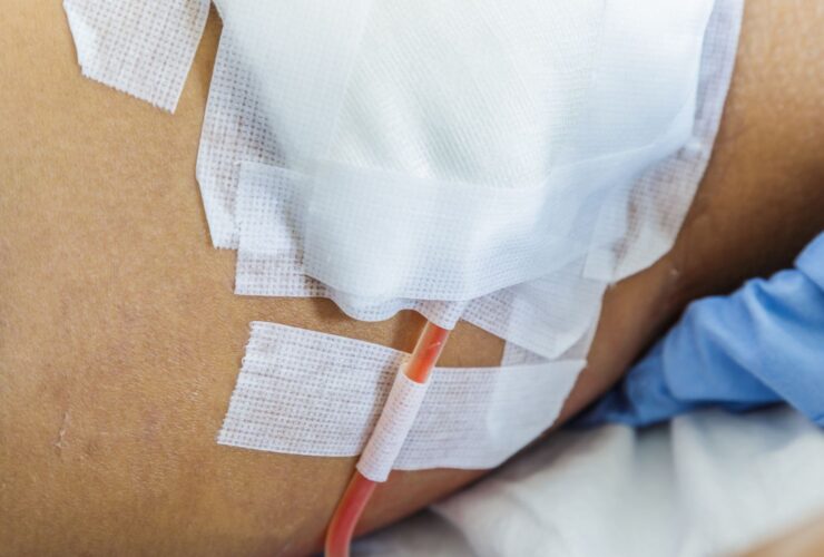 How to Care for Your Surgical Drain at Home