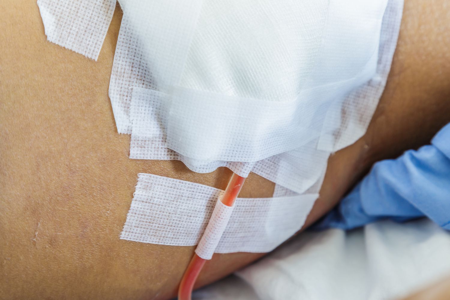 How to Care for Your Surgical Drain at Home