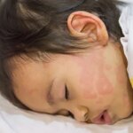 How to Manage Hives in Kids