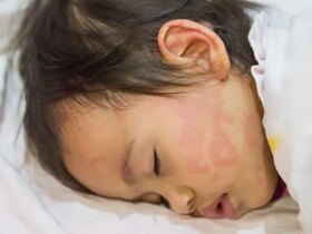 How to Manage Hives in Kids