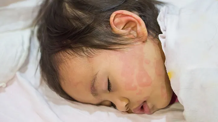 How to Manage Hives in Kids