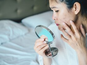 How to Recognize and Clear Up Fungal Acne