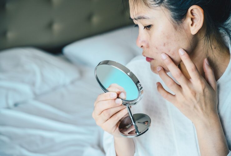 How to Recognize and Clear Up Fungal Acne