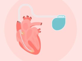 Hypertrophic Cardiomyopathy (HCM) and Implantable Devices: What to Know About ICDs (and Other Options)