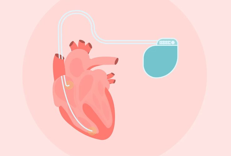 Hypertrophic Cardiomyopathy (HCM) and Implantable Devices: What to Know About ICDs (and Other Options)