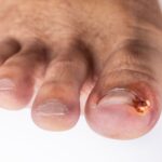 Ingrown Toenail Infection: Symptoms, Treatment, Causes