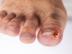 Ingrown Toenail Infection: Symptoms, Treatment, Causes