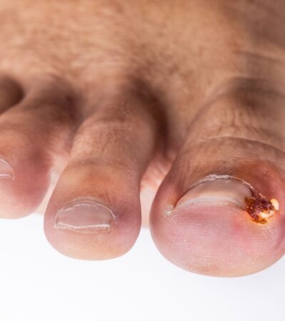 Ingrown Toenail Infection: Symptoms, Treatment, Causes