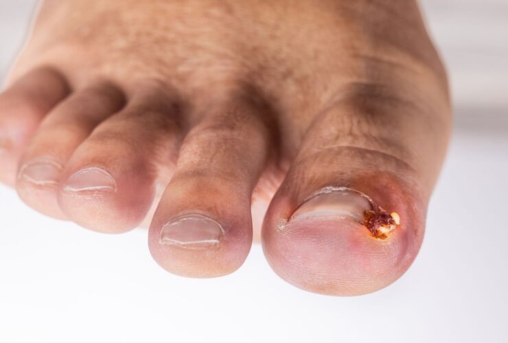Ingrown Toenail Infection: Symptoms, Treatment, Causes