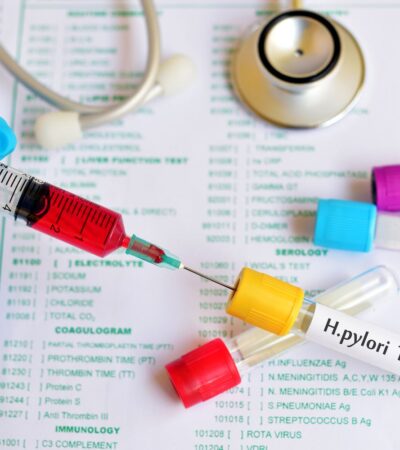 Intestinal Metaplasia: Symptoms, Causes, Treatment