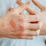 Is Your Atopic Dermatitis Well-Controlled? 3 Red Flags You Should Watch For