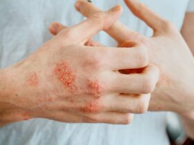 Is Your Atopic Dermatitis Well-Controlled? 3 Red Flags You Should Watch For