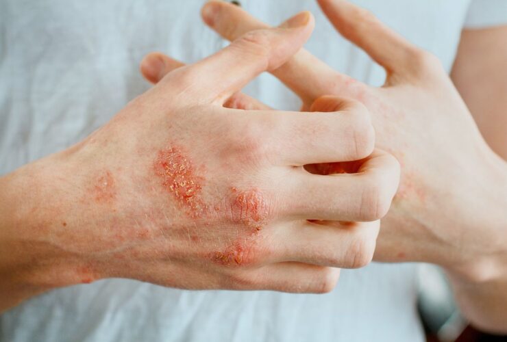 Is Your Atopic Dermatitis Well-Controlled? 3 Red Flags You Should Watch For