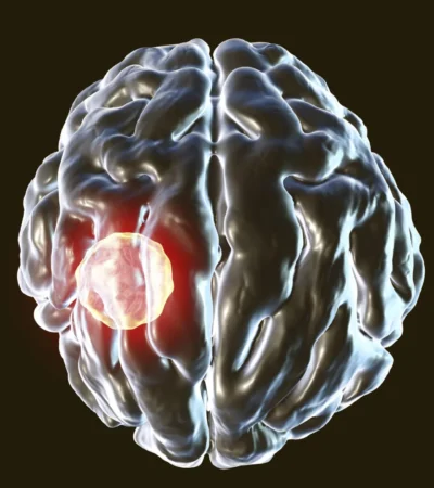 One in three people carry this brain parasite but the body has a kill switch