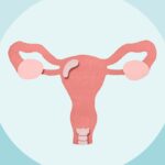 6 Ovarian Cancer Myths to Stop Believing Immediately