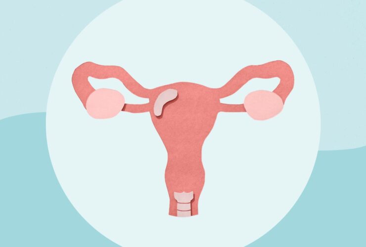 6 Ovarian Cancer Myths to Stop Believing Immediately