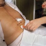 Sternal Precautions After Heart Surgery