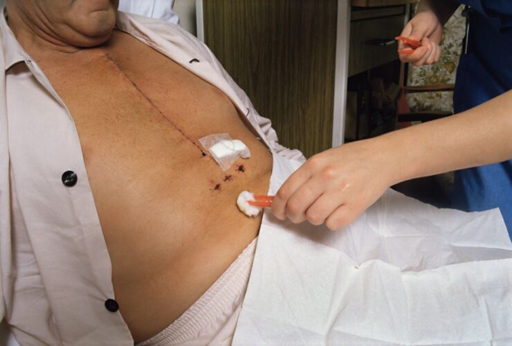 Sternal Precautions After Heart Surgery