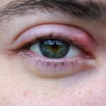 Stye on the Eyelid: Causes, Treatment, and More