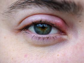 Stye on the Eyelid: Causes, Treatment, and More