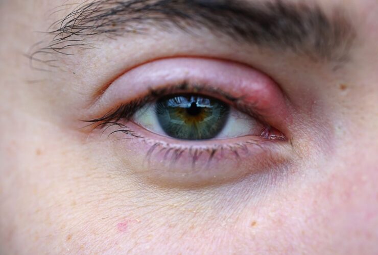 Stye on the Eyelid: Causes, Treatment, and More