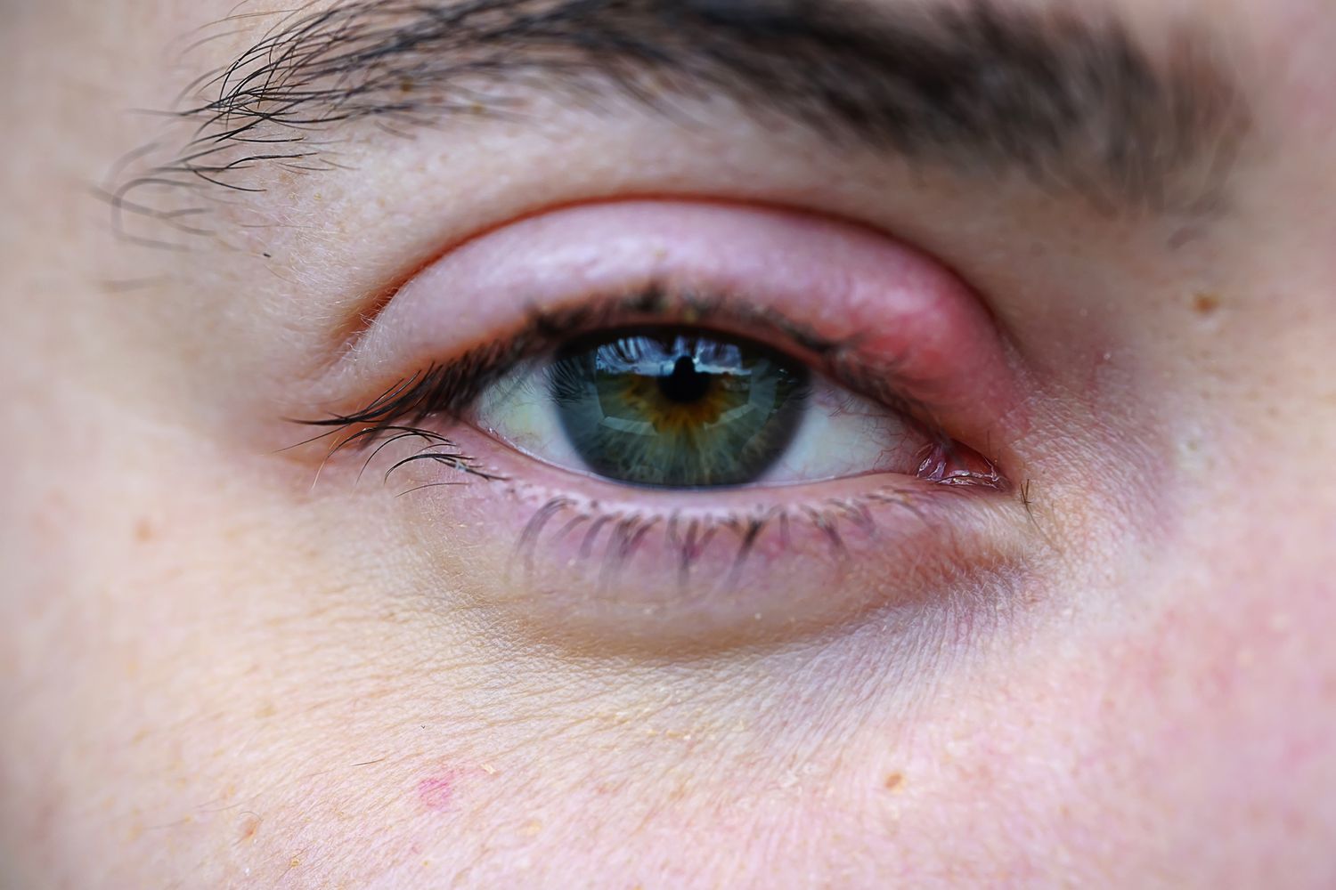Stye on the Eyelid: Causes, Treatment, and More