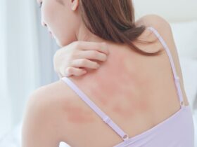 Topical Treatment for Hives: Types and Effectiveness