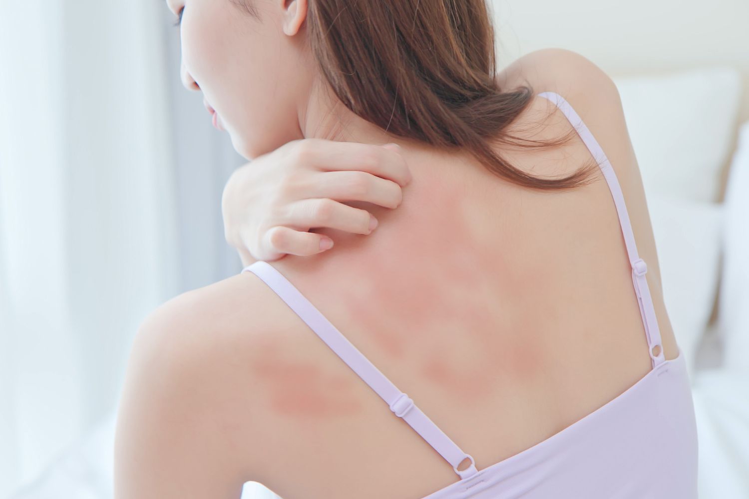 Topical Treatment for Hives: Types and Effectiveness