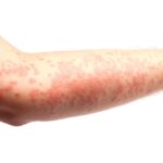 Welts: Symptoms, Causes, and Treatment