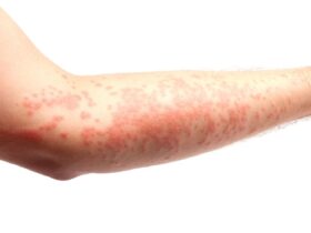Welts: Symptoms, Causes, and Treatment
