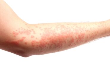Welts: Symptoms, Causes, and Treatment