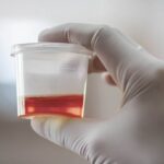 What Causes Blood in Urine (Hematuria)?