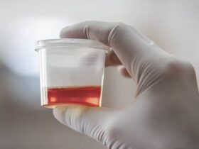 What Causes Blood in Urine (Hematuria)?